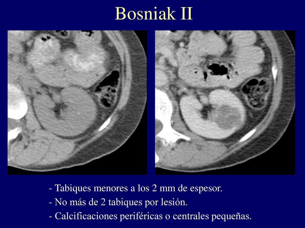 Bosniak II Tabiques menores a los 2 mm de espesor.