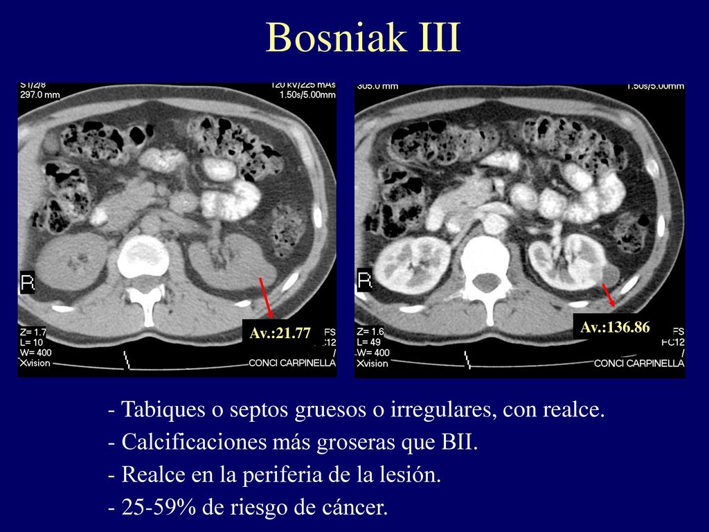 Bosniak III Tabiques o septos gruesos o irregulares, con realce.