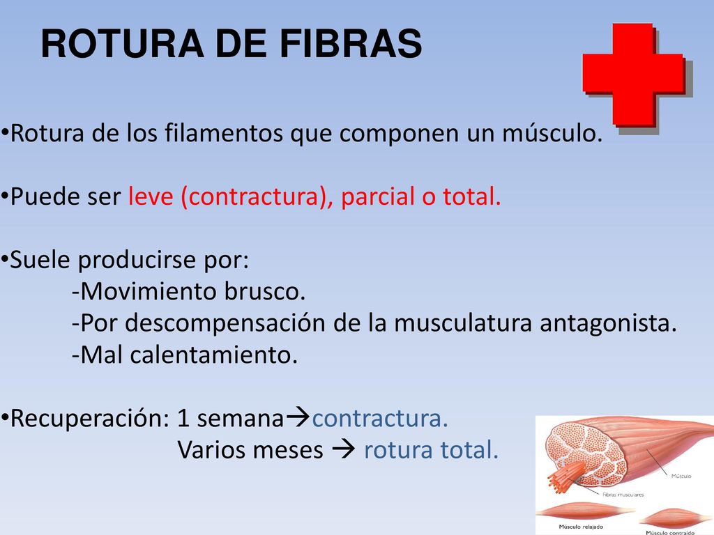 ROTURA DE FIBRAS Rotura de los filamentos que componen un músculo.