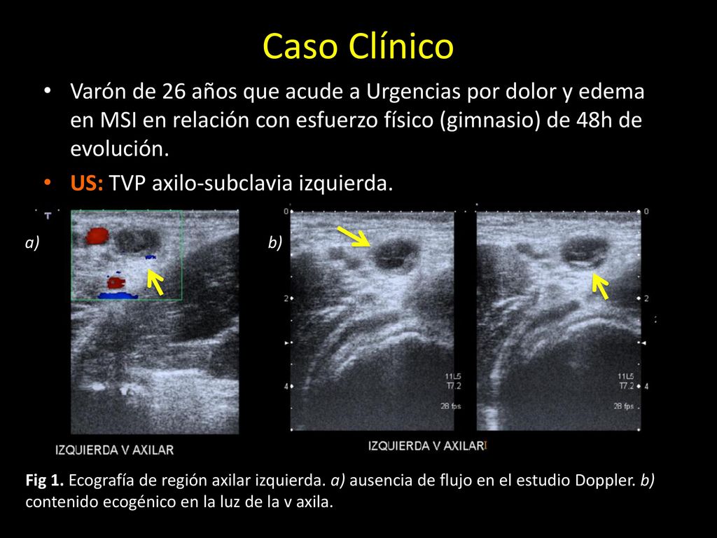 Caso Clínico Varón de 26 años que acude a Urgencias por dolor y edema en MSI en relación con esfuerzo físico (gimnasio) de 48h de evolución.