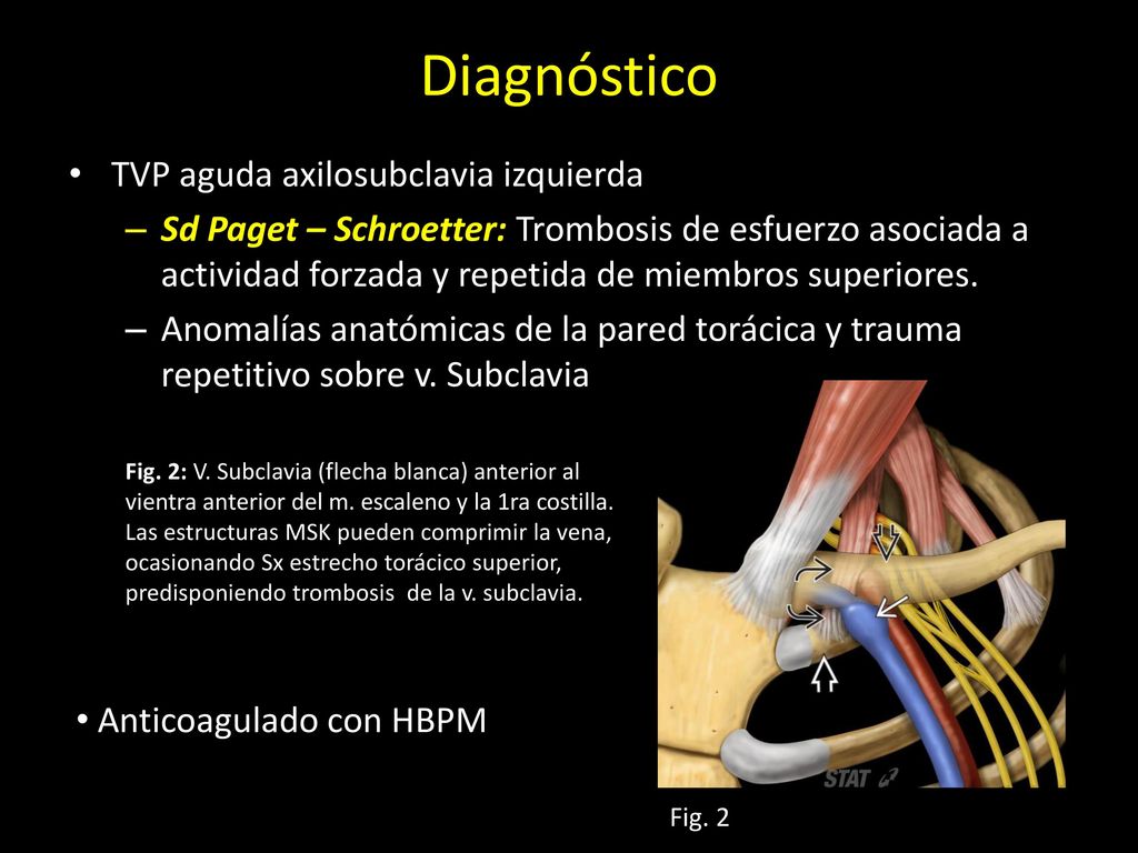 Diagnóstico TVP aguda axilosubclavia izquierda