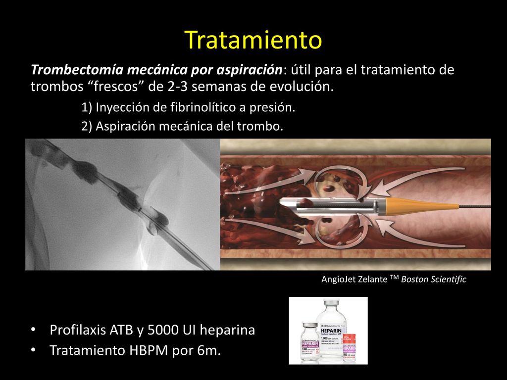 Tratamiento Trombectomía mecánica por aspiración: útil para el tratamiento de trombos frescos de 2-3 semanas de evolución.