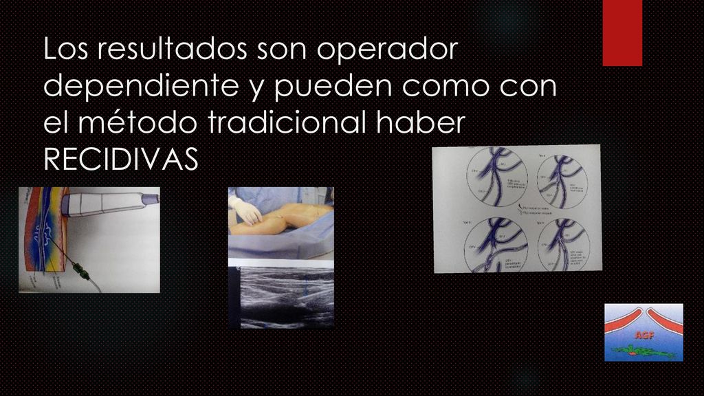 Los resultados son operador dependiente y pueden como con el método tradicional haber RECIDIVAS