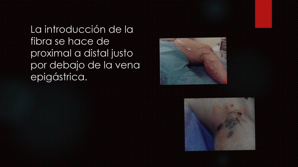 La introducción de la fibra se hace de proximal a distal justo por debajo de la vena epigástrica.