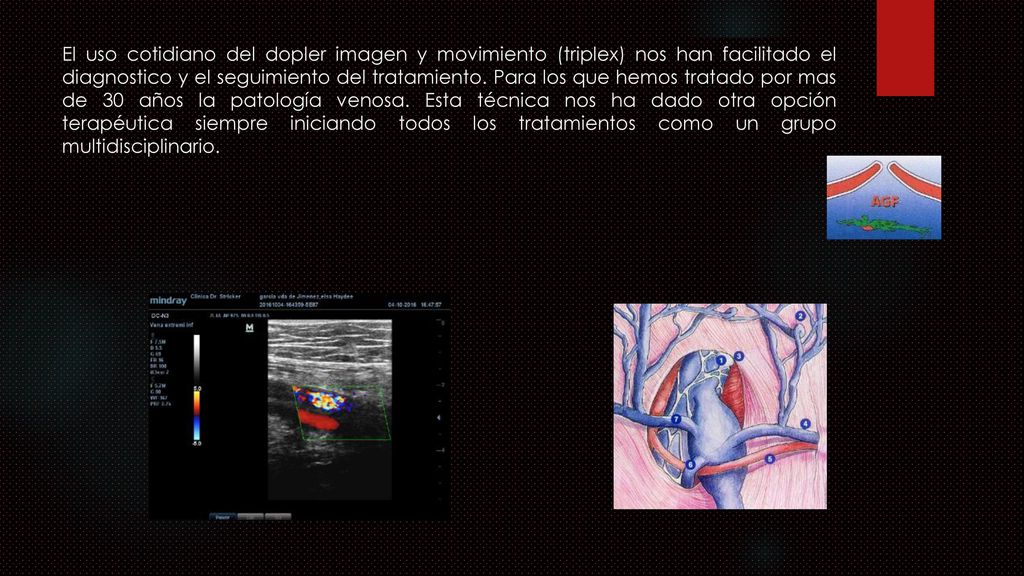 El uso cotidiano del dopler imagen y movimiento (triplex) nos han facilitado el diagnostico y el seguimiento del tratamiento.
