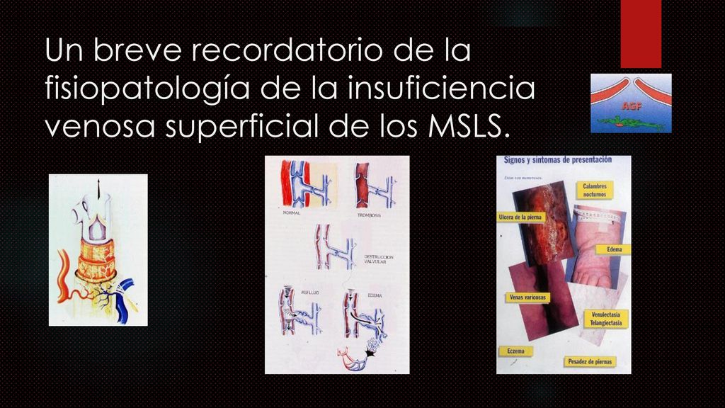 Un breve recordatorio de la fisiopatología de la insuficiencia venosa superficial de los MSLS.