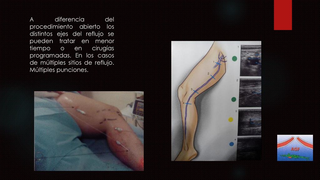 A diferencia del procedimiento abierto los distintos ejes del reflujo se pueden tratar en menor tiempo o en cirugías programadas.