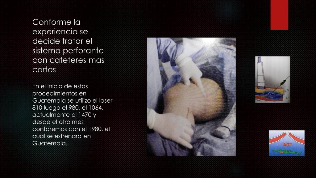 Conforme la experiencia se decide tratar el sistema perforante con cateteres mas cortos