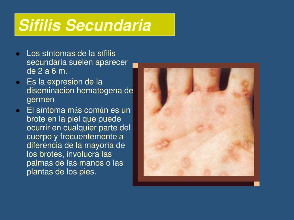 Sifilis Secundaria Los síntomas de la sífilis secundaria suelen aparecer de 2 a 6 m. Es la expresion de la diseminacion hematogena del germen.