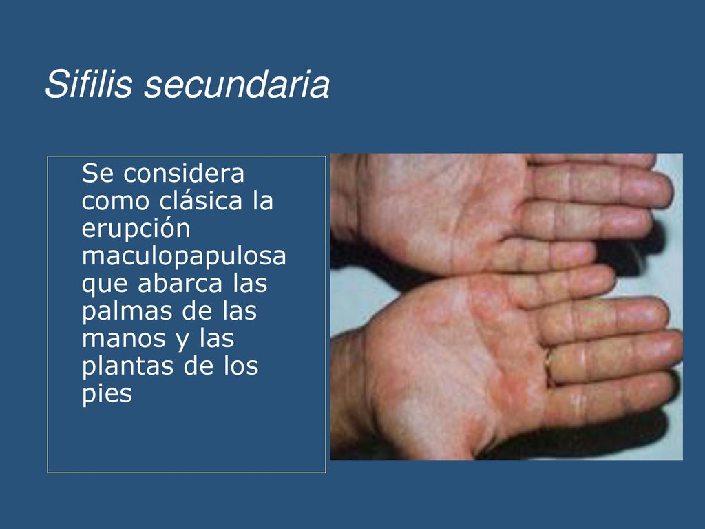 Sifilis secundaria Se considera como clásica la erupción maculopapulosa que abarca las palmas de las manos y las plantas de los pies.