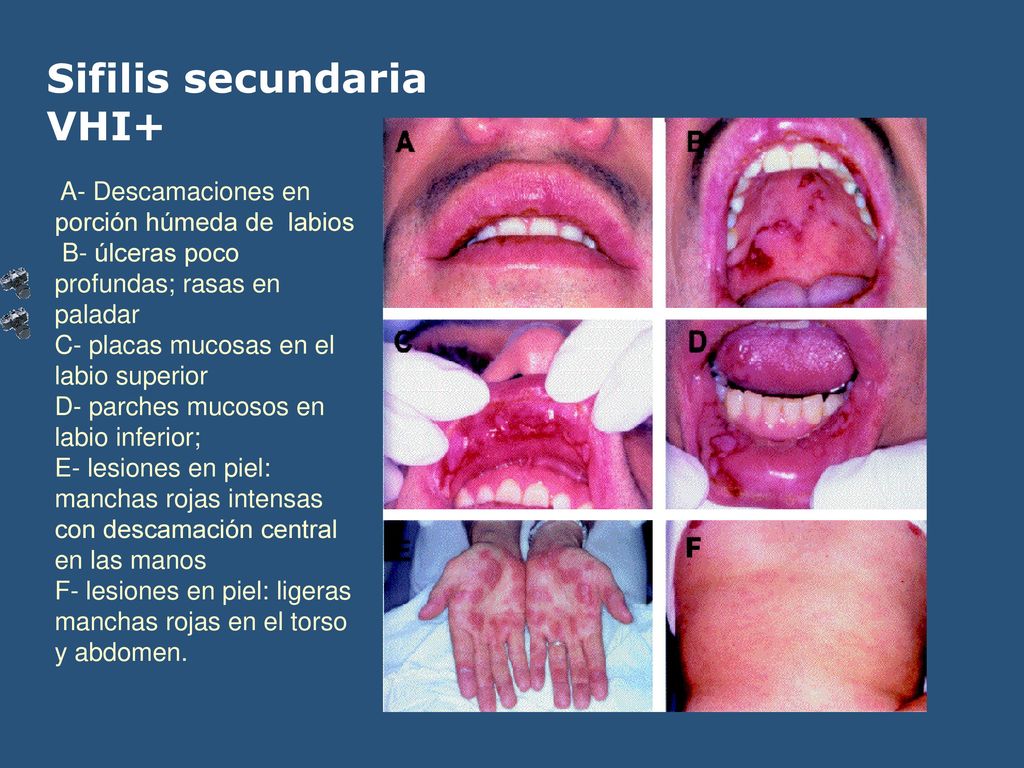 Sifilis secundaria VHI+ A- Descamaciones en porción húmeda de labios