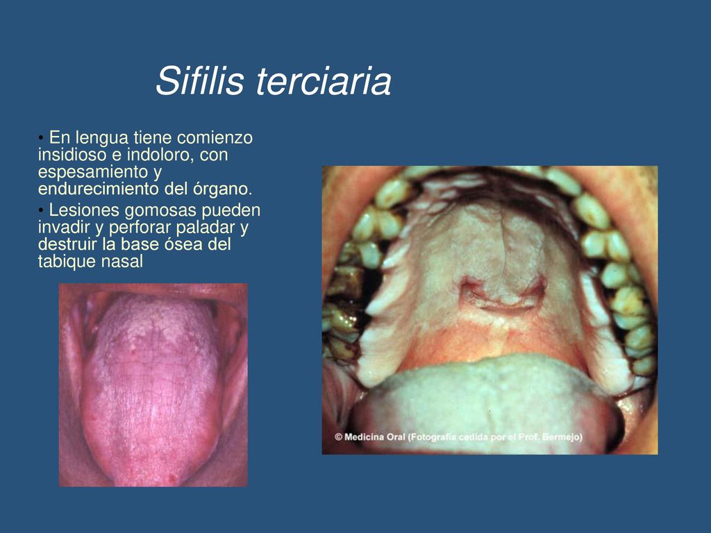 Sifilis terciaria En lengua tiene comienzo insidioso e indoloro, con espesamiento y endurecimiento del órgano.