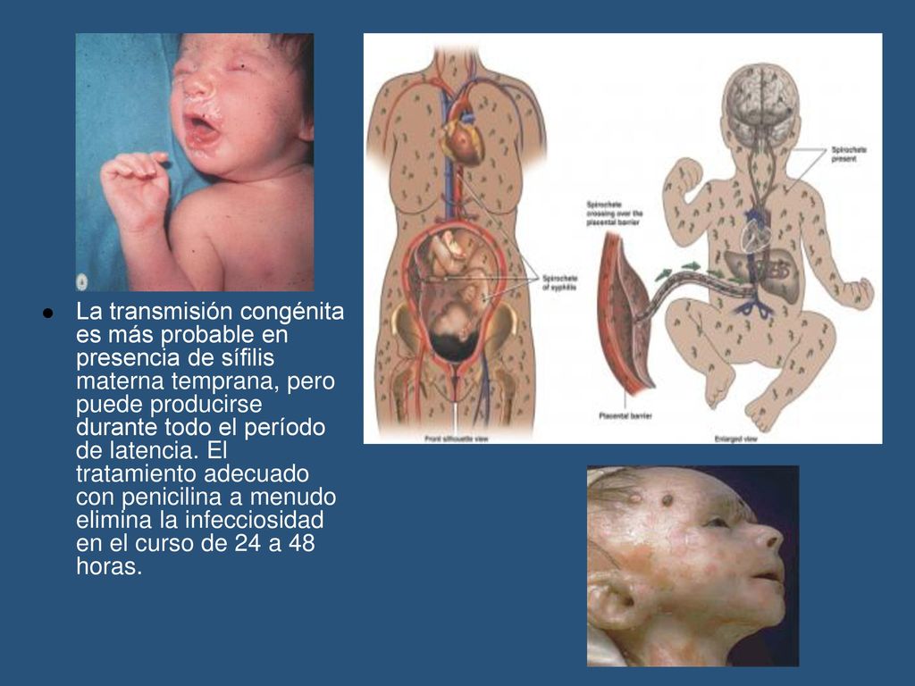 La transmisión congénita es más probable en presencia de sífilis materna temprana, pero puede producirse durante todo el período de latencia.