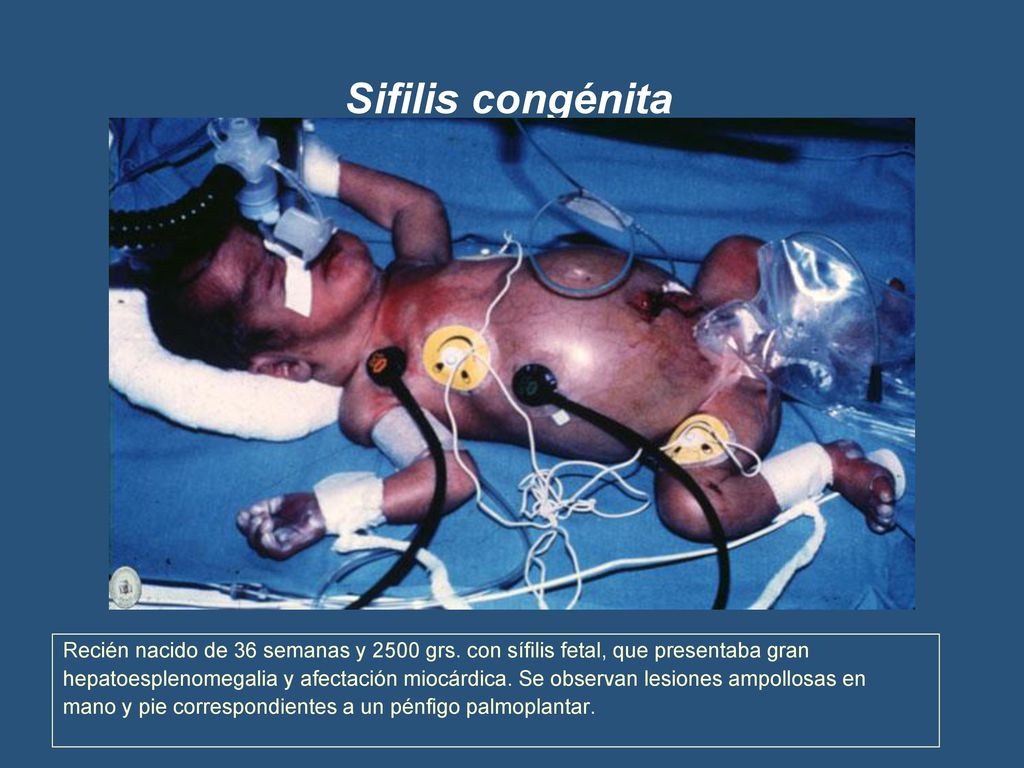 Sifilis congénita Recién nacido de 36 semanas y 2500 grs. con sífilis fetal, que presentaba gran.