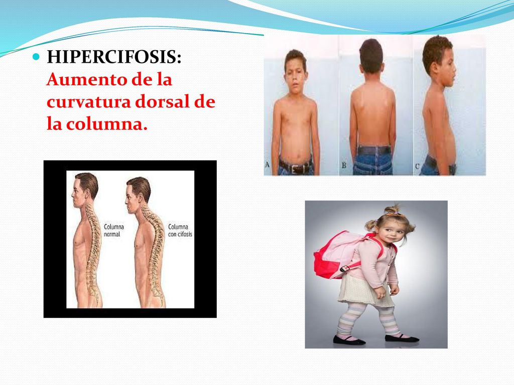 HIPERCIFOSIS: Aumento de la curvatura dorsal de la columna.
