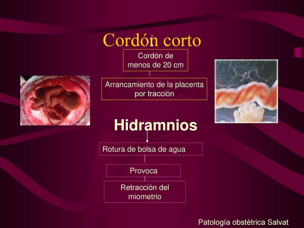 Cordón corto Hidramnios Cordón de menos de 20 cm