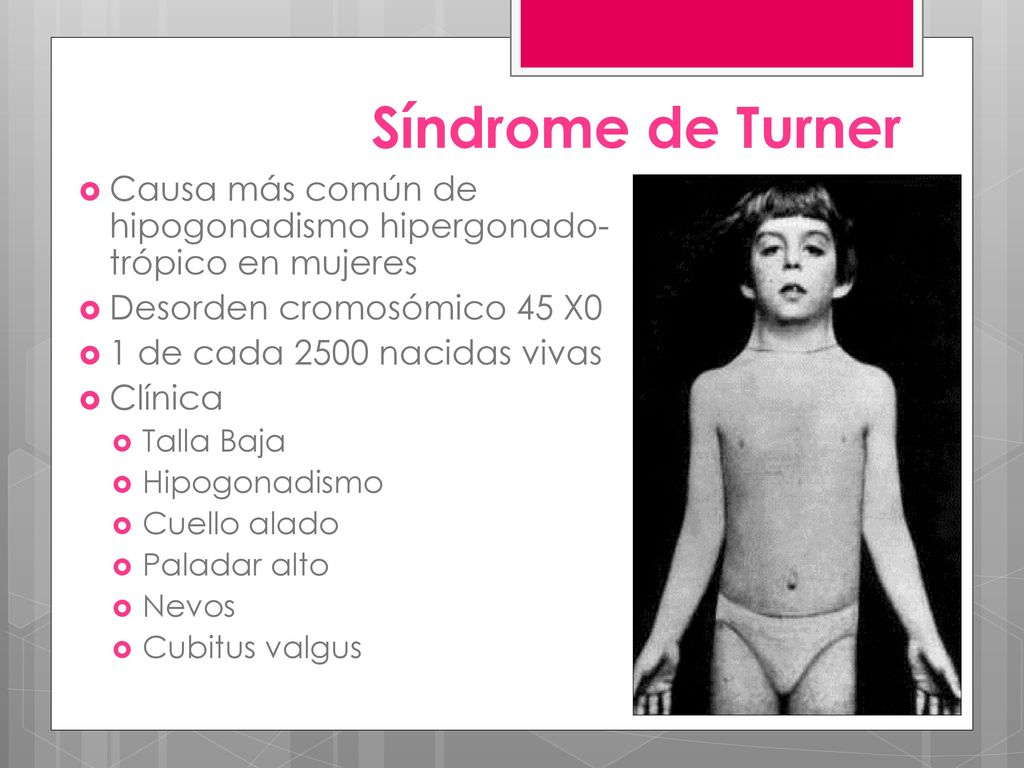 Síndrome de Turner Causa más común de hipogonadismo hipergonado-trópico en mujeres. Desorden cromosómico 45 X0.