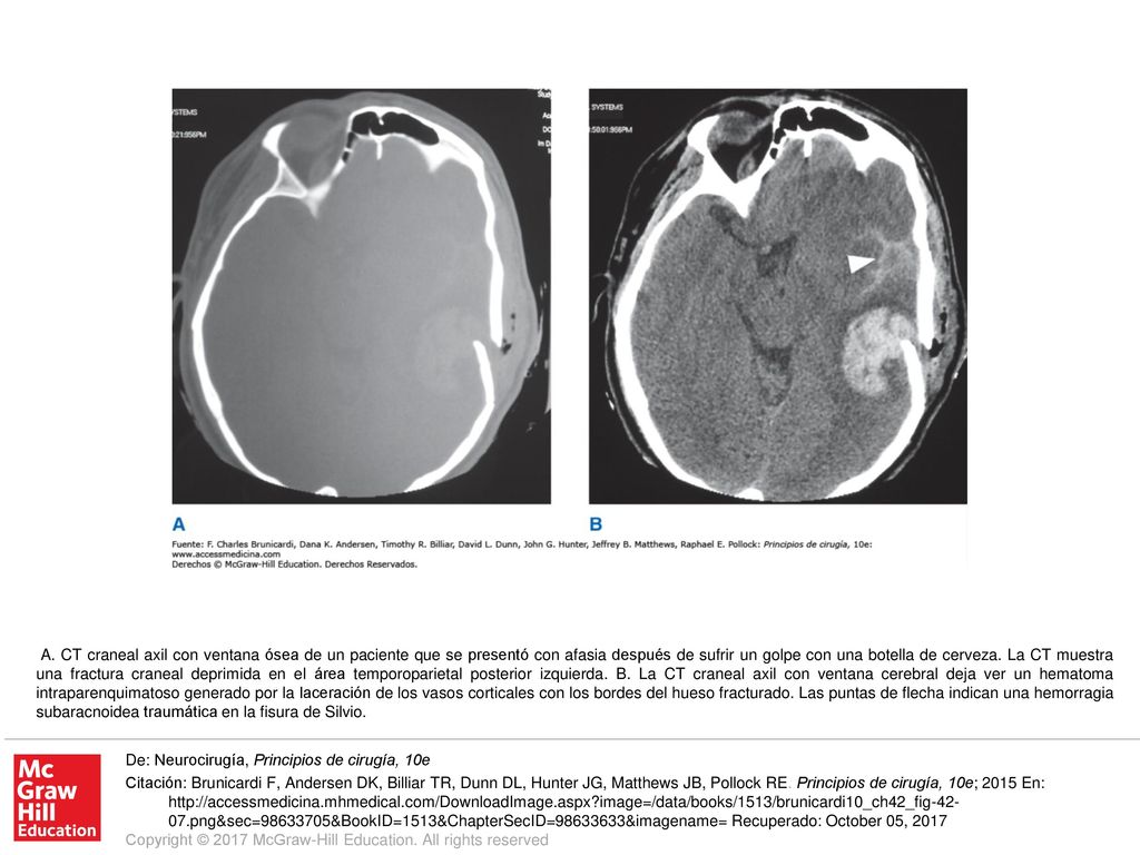 A. CT craneal axil con ventana ósea de un paciente que se presentó con afasia después de sufrir un golpe con una botella de cerveza. La CT muestra una fractura craneal deprimida en el área temporoparietal posterior izquierda. B. La CT craneal axil con ventana cerebral deja ver un hematoma intraparenquimatoso generado por la laceración de los vasos corticales con los bordes del hueso fracturado. Las puntas de flecha indican una hemorragia subaracnoidea traumática en la fisura de Silvio.
