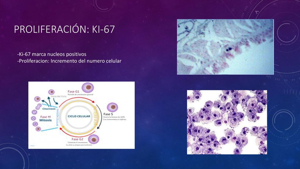 Proliferación: ki-67 -Ki-67 marca nucleos positivos