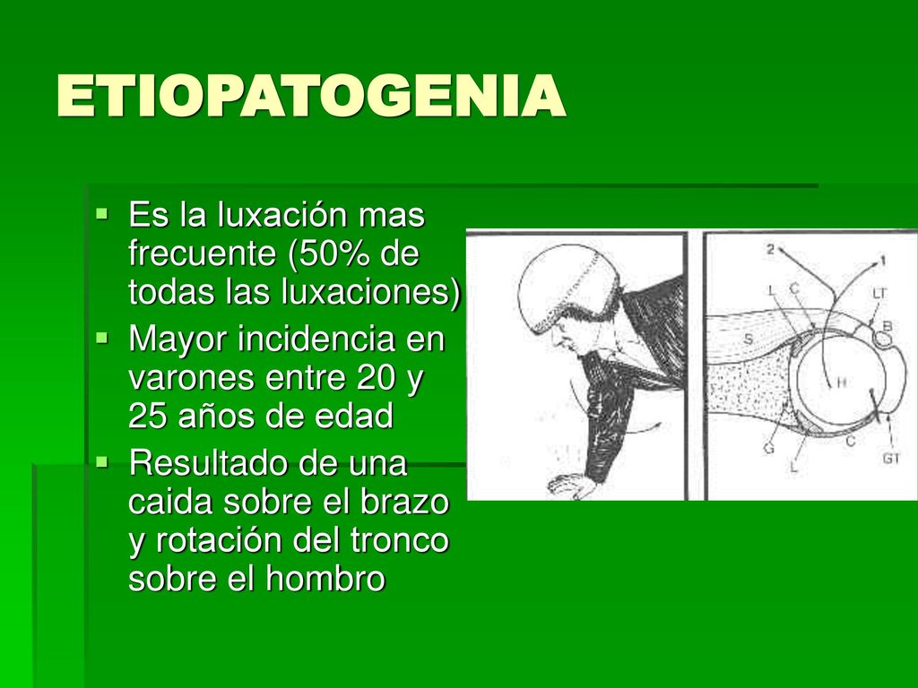 ETIOPATOGENIA Es la luxación mas frecuente (50% de todas las luxaciones) Mayor incidencia en varones entre 20 y 25 años de edad.