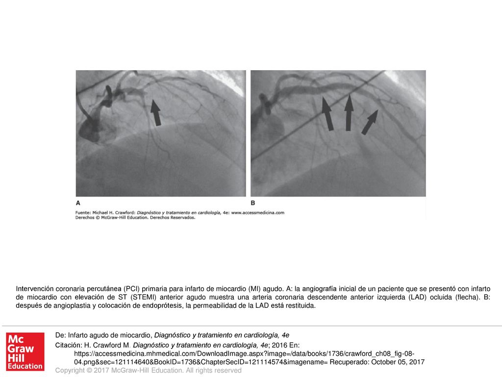 Intervención coronaria percutánea (PCI) primaria para infarto de miocardio (MI) agudo. A: la angiografía inicial de un paciente que se presentó con infarto de miocardio con elevación de ST (STEMI) anterior agudo muestra una arteria coronaria descendente anterior izquierda (LAD) ocluida (flecha). B: después de angioplastia y colocación de endoprótesis, la permeabilidad de la LAD está restituida.