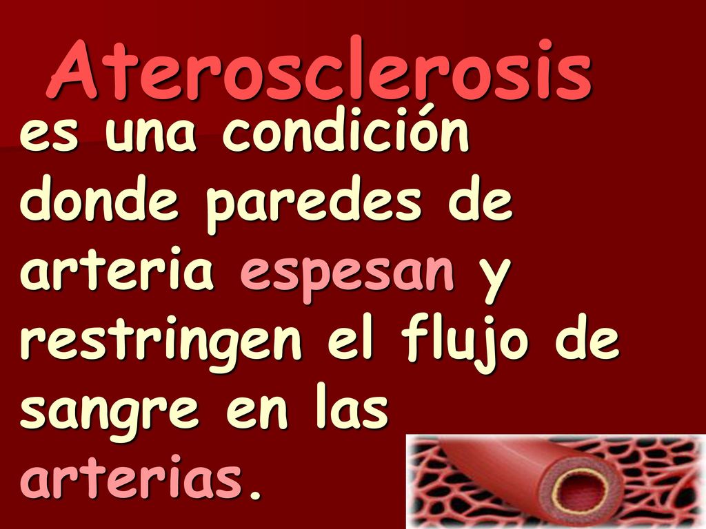 Aterosclerosis es una condición donde paredes de arteria espesan y restringen el flujo de sangre en las arterias.