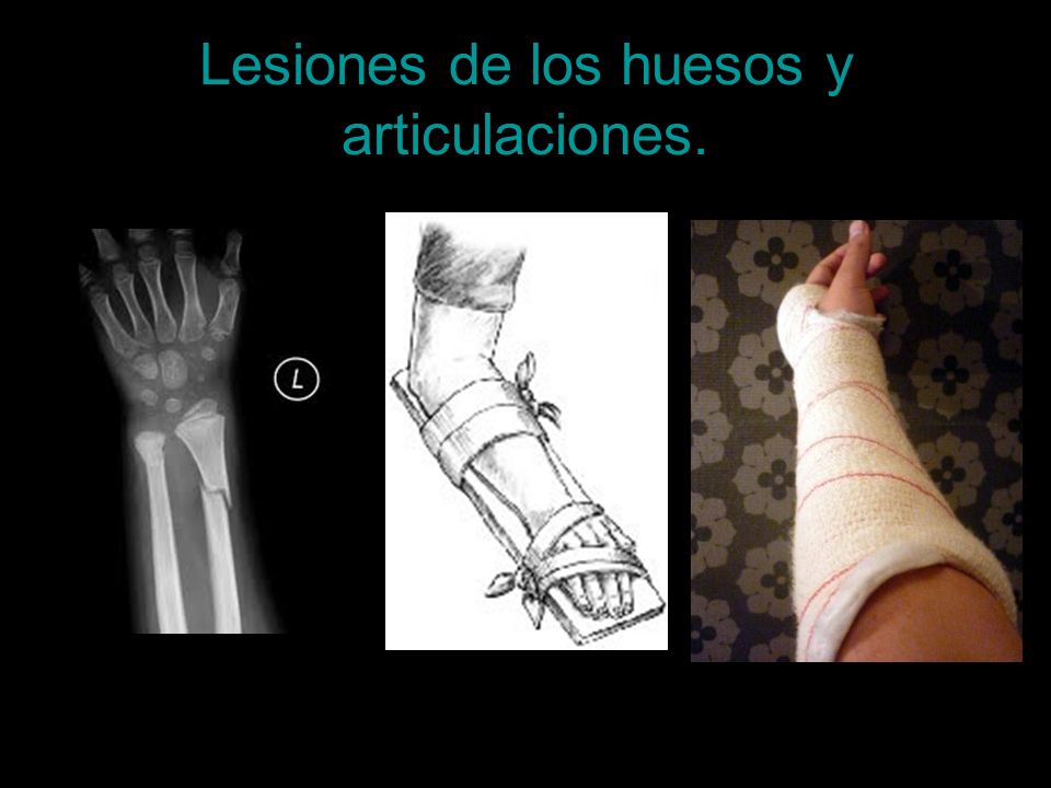 Lesiones de los huesos y articulaciones.