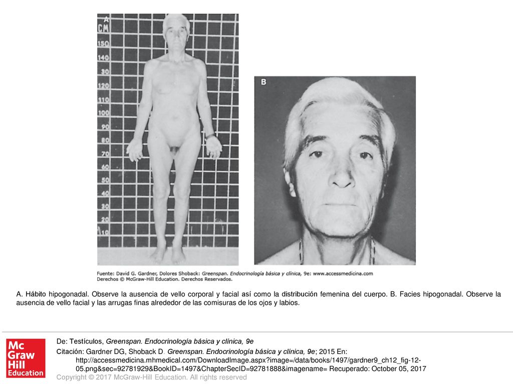 A. Hábito hipogonadal. Observe la ausencia de vello corporal y facial así como la distribución femenina del cuerpo. B. Facies hipogonadal. Observe la ausencia de vello facial y las arrugas finas alrededor de las comisuras de los ojos y labios.