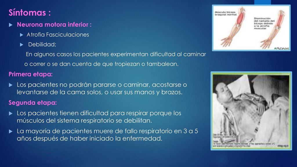 Síntomas : Neurona motora inferior : Primera etapa:
