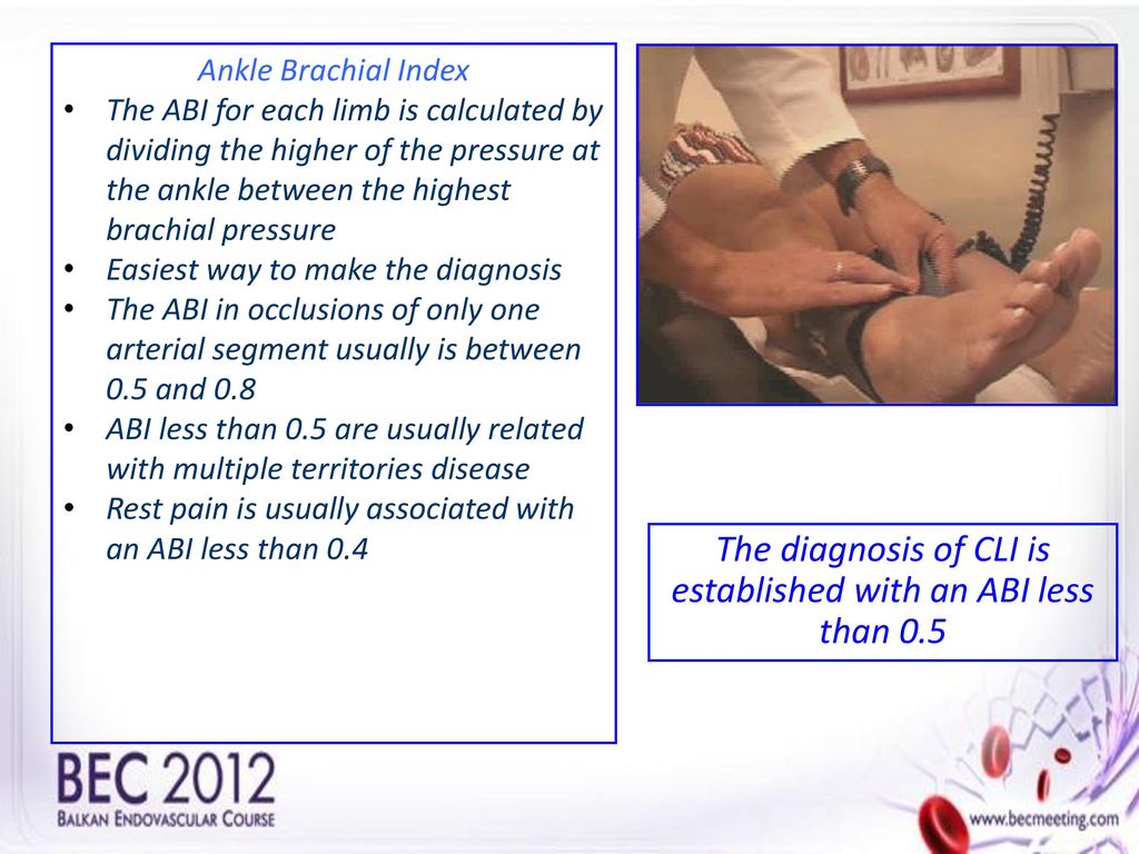 The diagnosis of CLI is established with an ABI less than 0.5