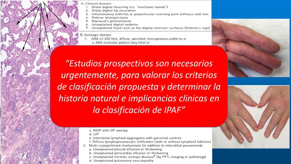 Estudios prospectivos son necesarios urgentemente, para valorar los criterios de clasificación propuesta y determinar la historia natural e implicancias clinicas en la clasificación de IPAF