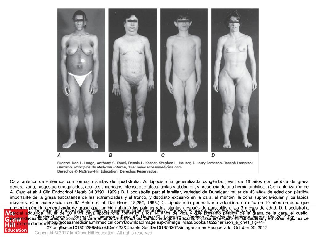 Cara anterior de enfermos con formas distintas de lipodistrofia. A