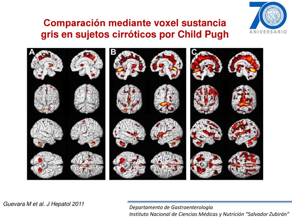 Comparación mediante voxel sustancia gris en sujetos cirróticos por Child Pugh