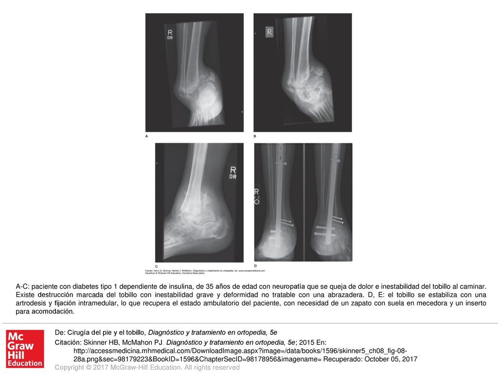 A-C: paciente con diabetes tipo 1 dependiente de insulina, de 35 años de edad con neuropatía que se queja de dolor e inestabilidad del tobillo al caminar. Existe destrucción marcada del tobillo con inestabilidad grave y deformidad no tratable con una abrazadera. D, E: el tobillo se estabiliza con una artrodesis y fijación intramedular, lo que recupera el estado ambulatorio del paciente, con necesidad de un zapato con suela en mecedora y un inserto para acomodación.