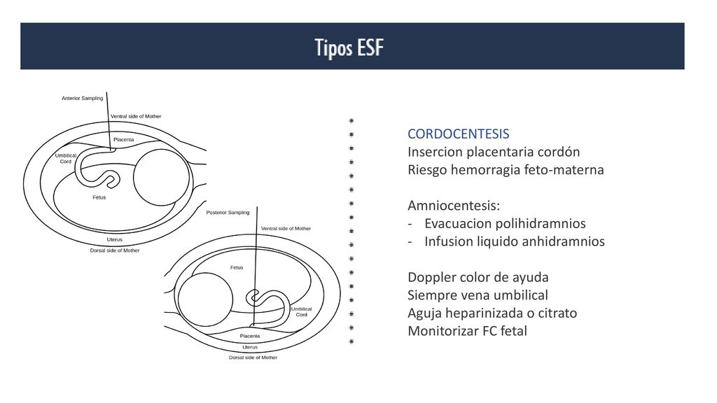 CORDOCENTESIS Insercion placentaria cordón. Riesgo hemorragia feto-materna. Amniocentesis: Evacuacion polihidramnios.