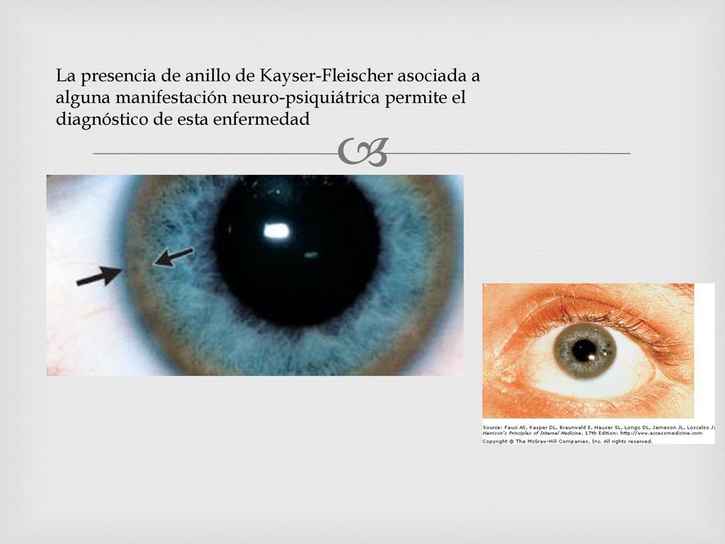 La presencia de anillo de Kayser-Fleischer asociada a alguna manifestación neuro-psiquiátrica permite el diagnóstico de esta enfermedad