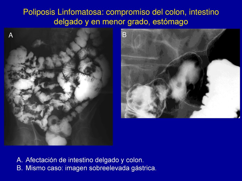 Poliposis Linfomatosa: compromiso del colon, intestino delgado y en menor grado, estómago