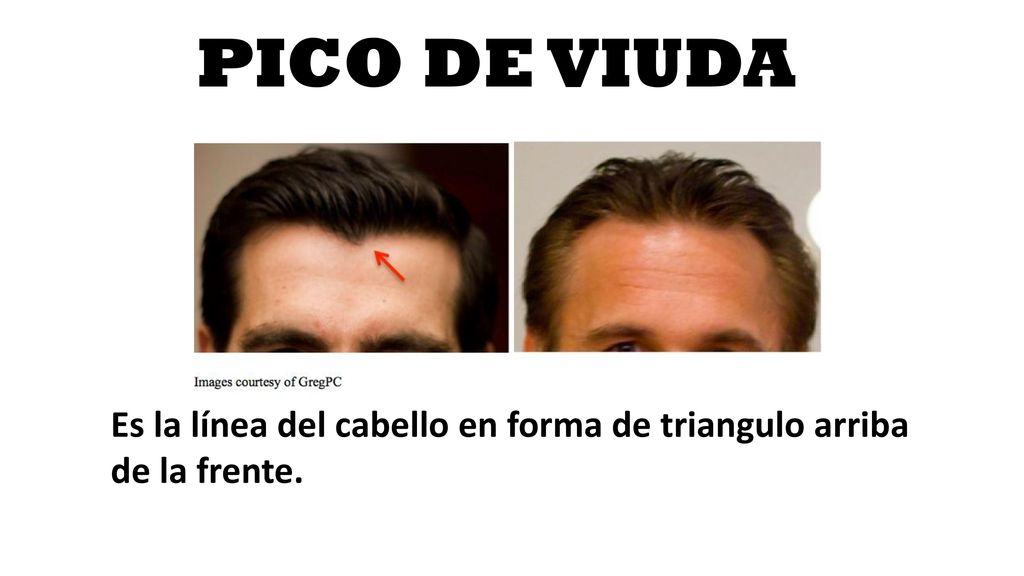 PICO DE VIUDA Es la línea del cabello en forma de triangulo arriba de la frente.
