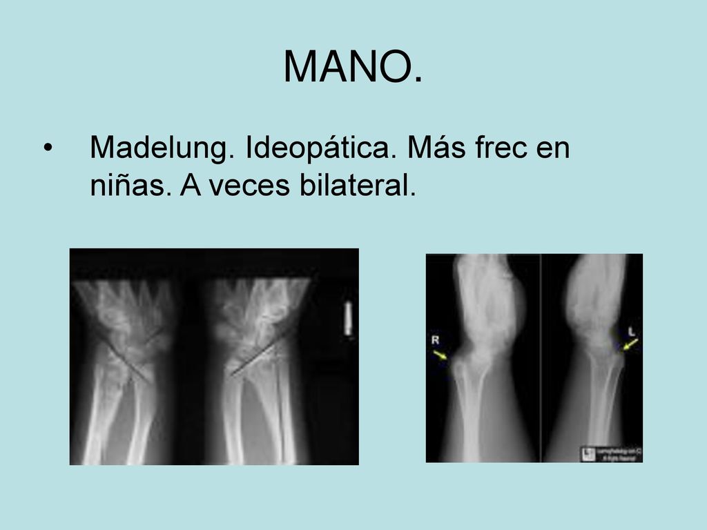 MANO. Madelung. Ideopática. Más frec en niñas. A veces bilateral.