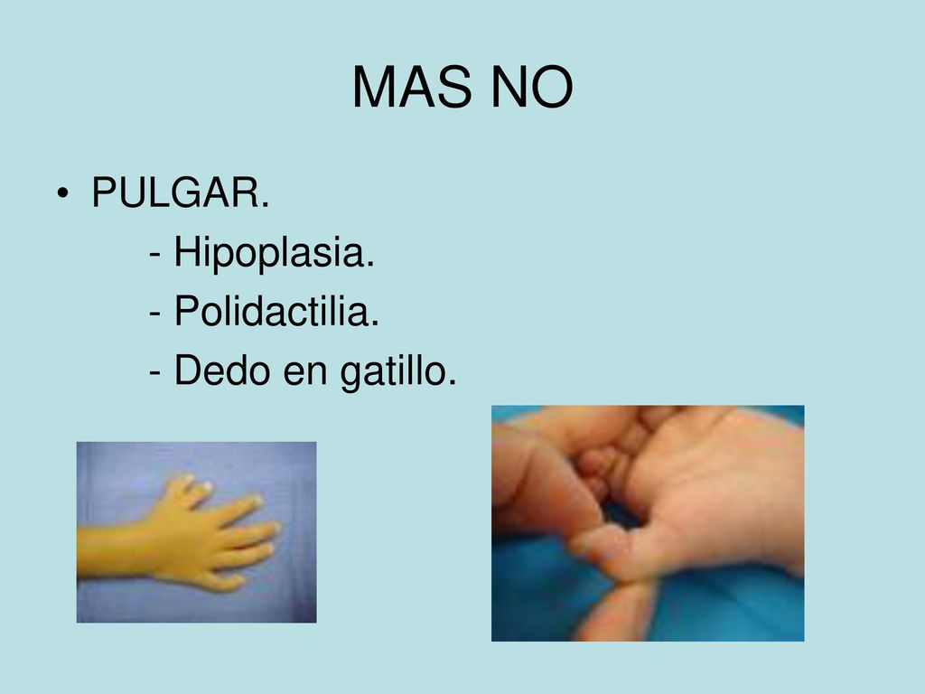 MAS NO PULGAR. - Hipoplasia. - Polidactilia. - Dedo en gatillo.