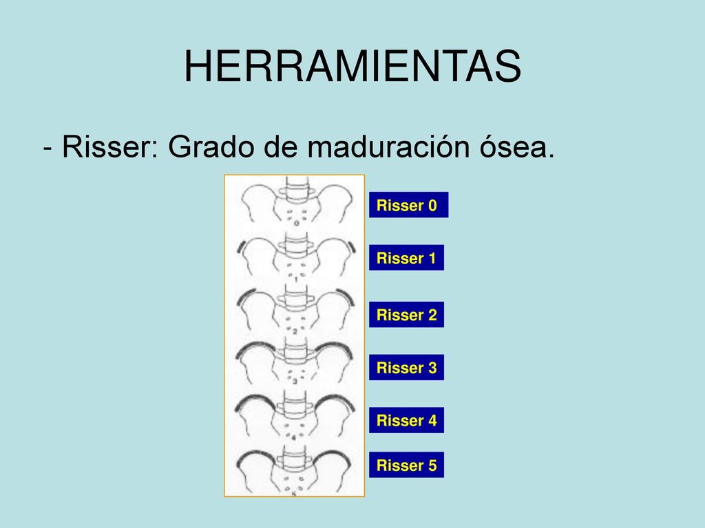 HERRAMIENTAS - Risser: Grado de maduración ósea. Risser 0 Risser 1