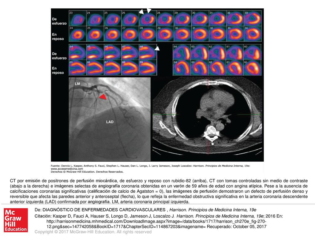 CT por emisión de positrones de perfusión miocárdica, de esfuerzo y reposo con rubidio-82 (arriba), CT con tomas controladas sin medio de contraste (abajo a la derecha) e imágenes selectas de angiografía coronaria obtenidas en un varón de 59 años de edad con angina atípica. Pese a la ausencia de calcificaciones coronarias significativas (calificación de calcio de Agatston = 0), las imágenes de perfusión demostraron un defecto de perfusión denso y reversible que afecta las paredes anterior y anteroseptal (flecha), lo que refleja la enfermedad obstructiva significativa en la arteria coronaria descendente anterior izquierda (LAD) confirmada por angiografía. LM, arteria coronaria principal izquierda.