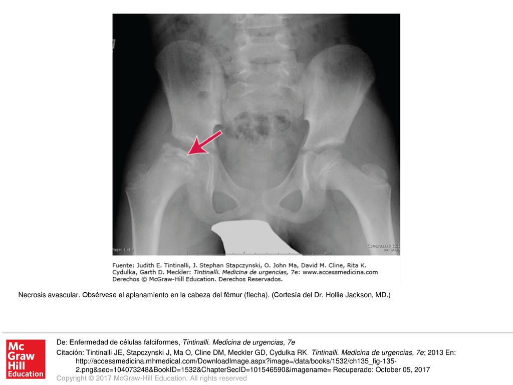 Necrosis avascular. Obsérvese el aplanamiento en la cabeza del fémur (flecha). (Cortesía del Dr. Hollie Jackson, MD.)