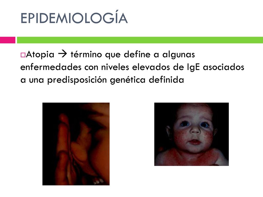 EPIDEMIOLOGÍA Atopia  término que define a algunas enfermedades con niveles elevados de IgE asociados a una predisposición genética definida.