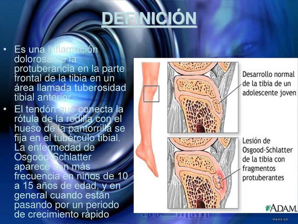 DEFINICIÓN Es una inflamación dolorosa de la protuberancia en la parte frontal de la tibia en un área llamada tuberosidad tibial anterior.