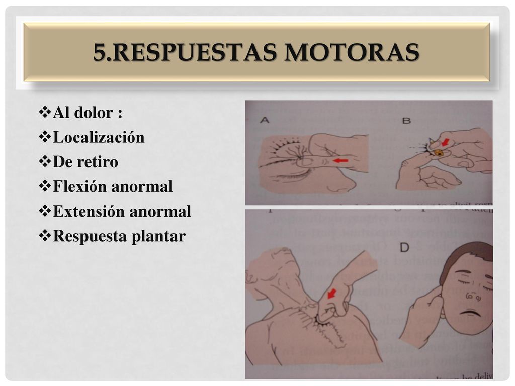 5.Respuestas motoras Al dolor : Localización De retiro Flexión anormal