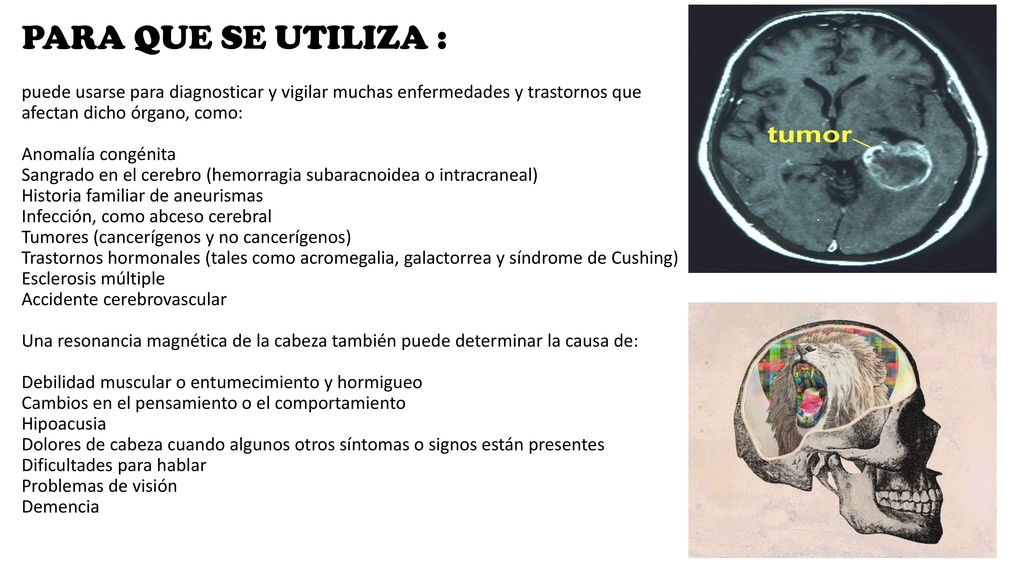 PARA QUE SE UTILIZA : puede usarse para diagnosticar y vigilar muchas enfermedades y trastornos que afectan dicho órgano, como: Anomalía congénita Sangrado en el cerebro (hemorragia subaracnoidea o intracraneal) Historia familiar de aneurismas Infección, como abceso cerebral Tumores (cancerígenos y no cancerígenos) Trastornos hormonales (tales como acromegalia, galactorrea y síndrome de Cushing) Esclerosis múltiple Accidente cerebrovascular Una resonancia magnética de la cabeza también puede determinar la causa de: Debilidad muscular o entumecimiento y hormigueo Cambios en el pensamiento o el comportamiento Hipoacusia Dolores de cabeza cuando algunos otros síntomas o signos están presentes Dificultades para hablar Problemas de visión Demencia