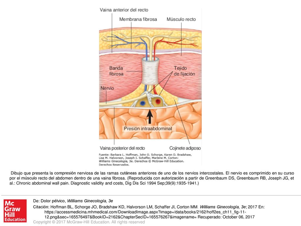 Dibujo que presenta la compresión nerviosa de las ramas cutáneas anteriores de uno de los nervios intercostales. El nervio es comprimido en su curso por el músculo recto del abdomen dentro de una vaina fibrosa. (Reproducida con autorización a partir de Greenbaum DS, Greenbaum RB, Joseph JG, et al.: Chronic abdominal wall pain. Diagnostic validity and costs, Dig Dis Sci 1994 Sep;39(9): )
