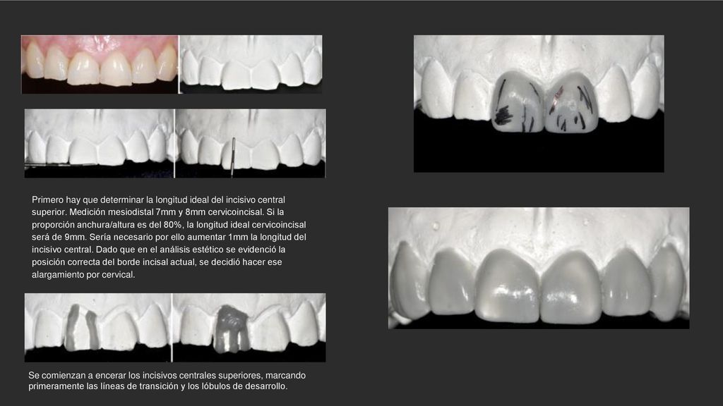 Primero hay que determinar la longitud ideal del incisivo central superior. Medición mesiodistal 7mm y 8mm cervicoincisal. Si la proporción anchura/altura es del 80%, la longitud ideal cervicoincisal será de 9mm. Sería necesario por ello aumentar 1mm la longitud del incisivo central. Dado que en el análisis estético se evidenció la posición correcta del borde incisal actual, se decidió hacer ese alargamiento por cervical.