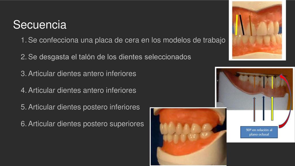 Secuencia Se confecciona una placa de cera en los modelos de trabajo